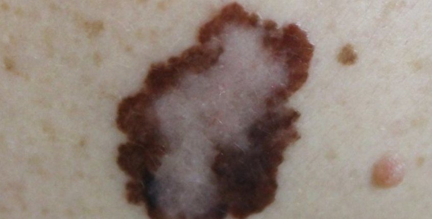 Everything You Need to Know Before Your First Botox Treatment in Huntington Beach