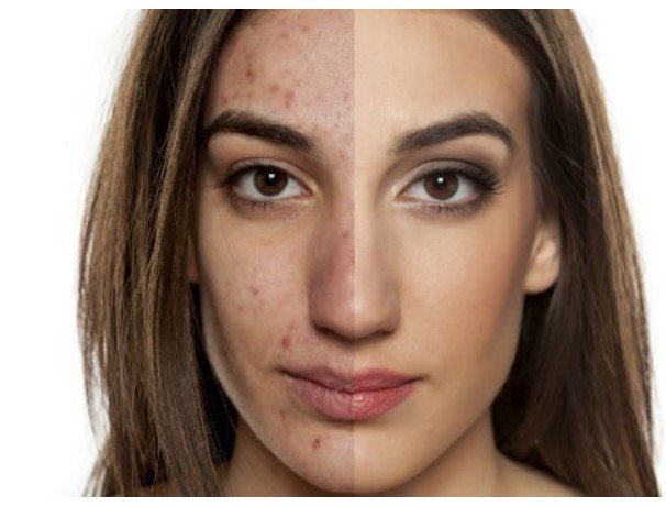 How to Choose the Best Wrinkles Treatment and Dermal Fillers in Huntington Beach, CA: A Complete Guide